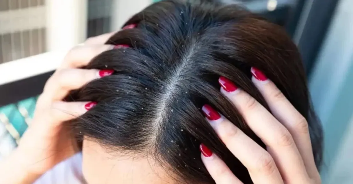 Dandruff on the head even in summer how to get rid of it
