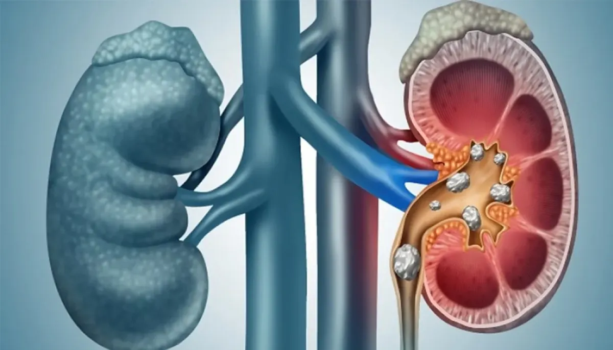 Fruits that reduce the risk of kidney stones if eaten regularly