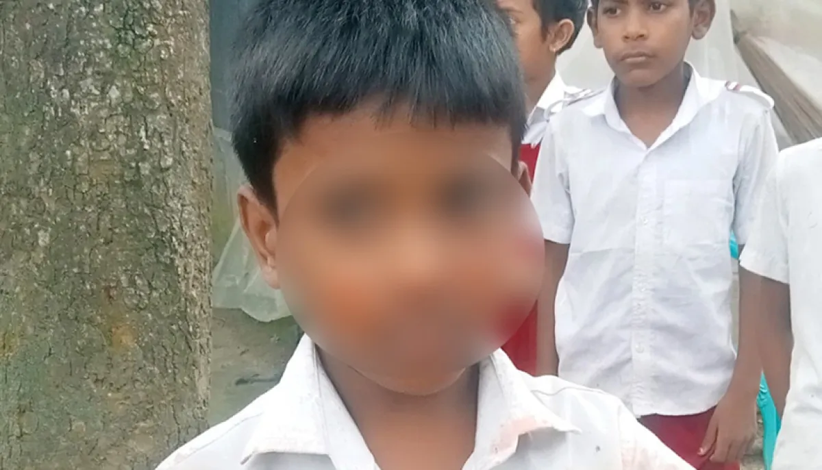 Child students nose fractured after being slapped by teacher