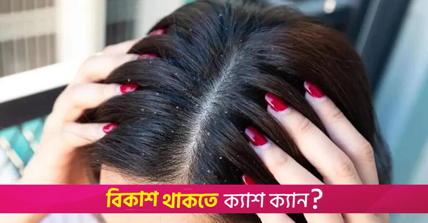 গরমেও মাথা ভর্তি খুশকি? দূর করবেন যেভাবে | লাইফস্টাইল নিউজ 
